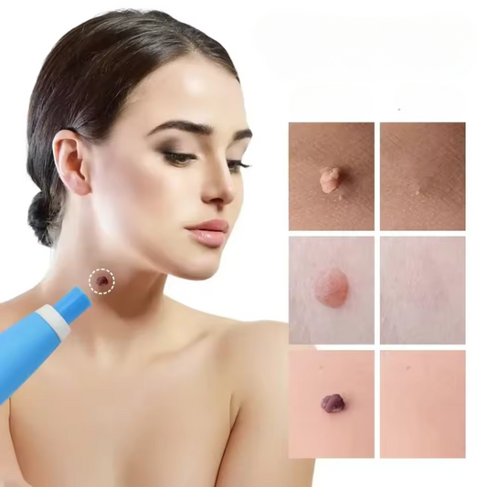 VerrueStop Éliminateur d’acrochordons Nusikana